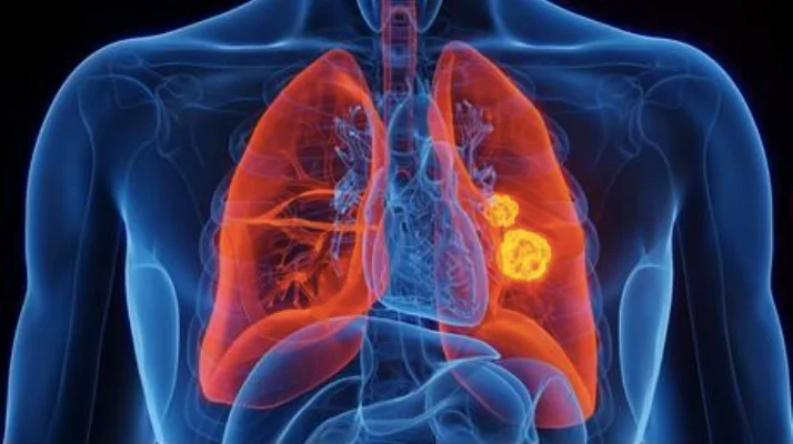 Lung Cancer Screening