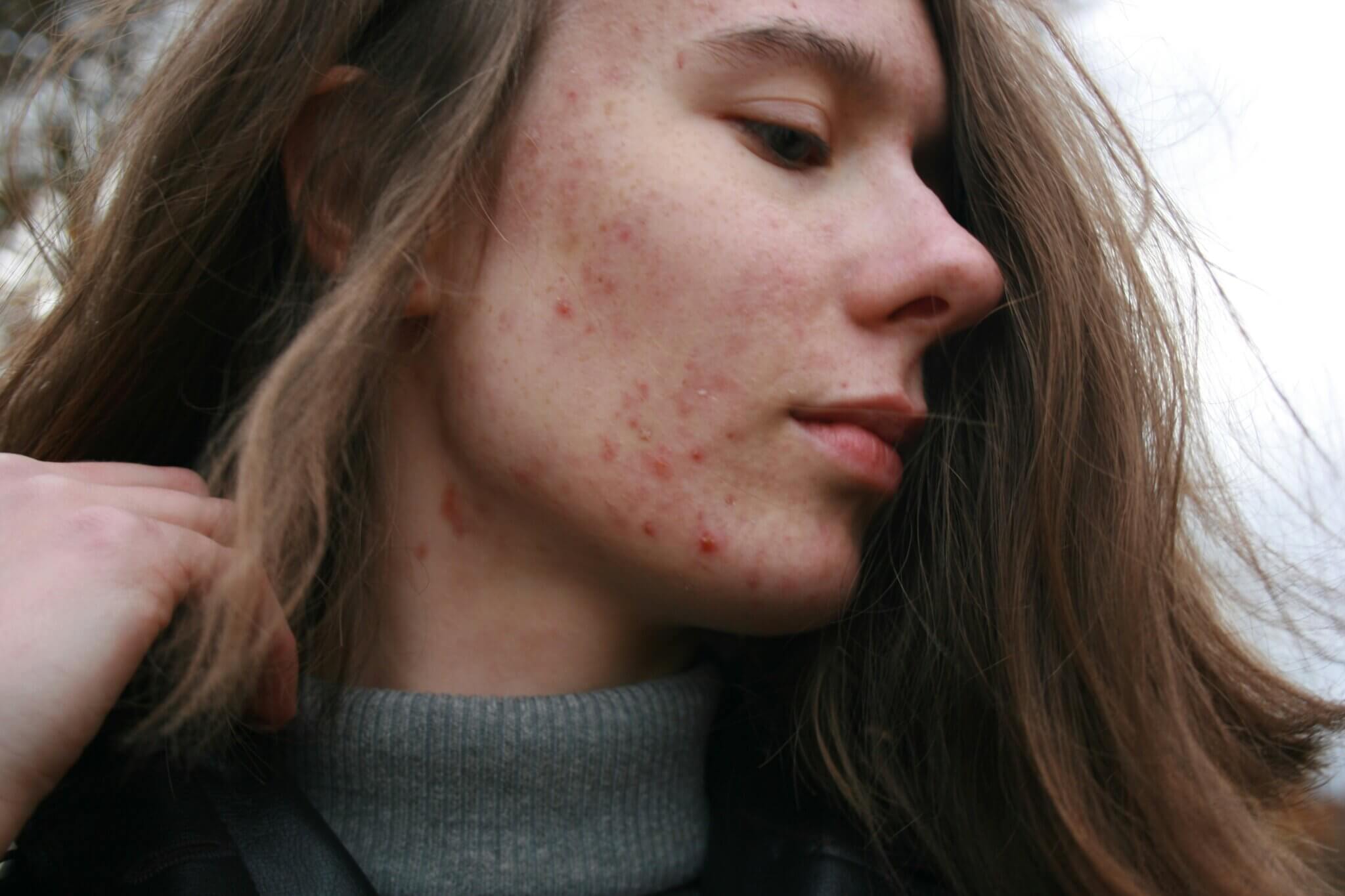 teen with acne
